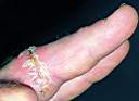 Two weeks after the finger-in-the-winch incident